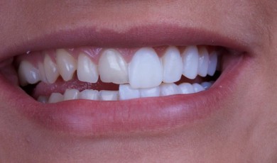 Bọc sứ răng thưa giải pháp hiệu quả cho những chiếc răng thưa hở kẽ.