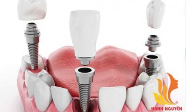 Trồng răng Implant 4S vô cùng an toàn – hiệu quả trọn đời