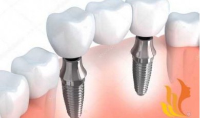 Làm răng implant có nguy hiểm không?