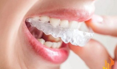Những điều cần biết khi niềng răng bằng phương pháp niềng răng tháo lắp