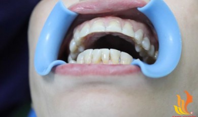Trám răng thẩm mỹ – giải pháp nha khoa hiệu quả
