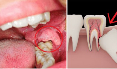 Những biến chứng có thể xảy ra khi nhổ răng khôn